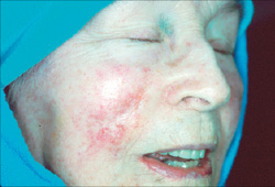 Photo of Skin Cancer