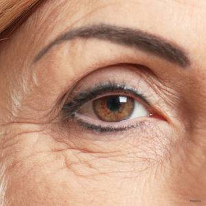 Heavy Wrinkle Reduction