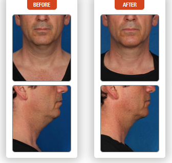 Kybella before and after 4