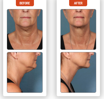 kybella before and after 2