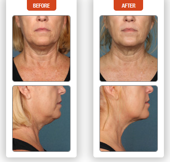 kybella before and after 3
